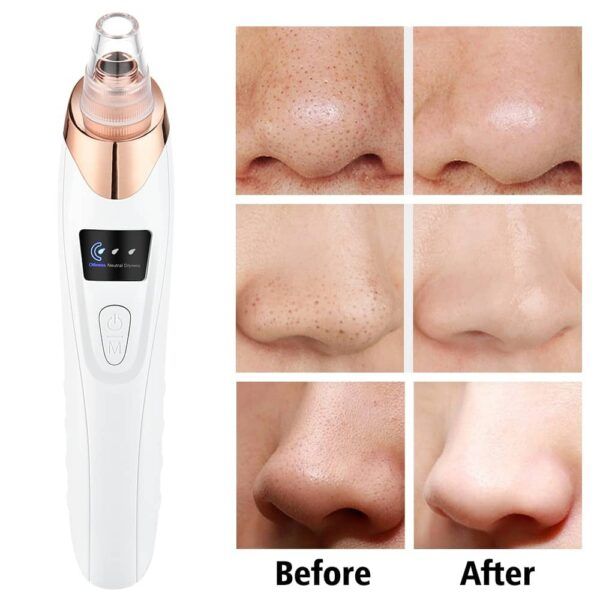 5 in 1 Blackhead remover | Derma Suction | Rechargeable | Free Gift Card 🎁 - Nuvenza